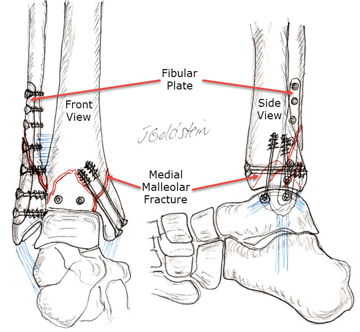 Ankle Fracture Fixation