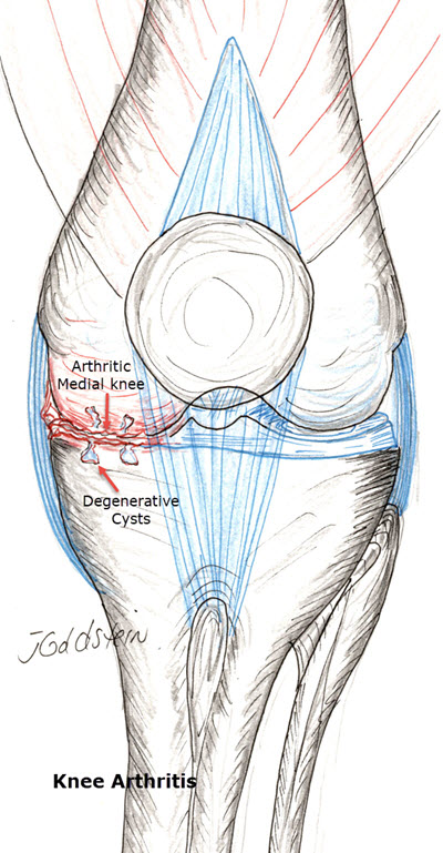 Arthritic Knee