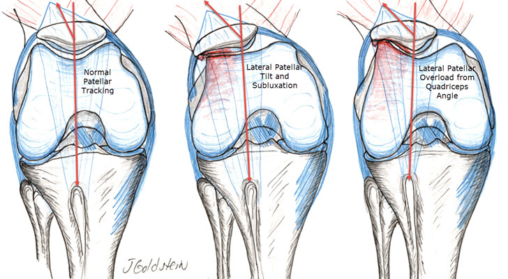 Kneecap on sale not aligned