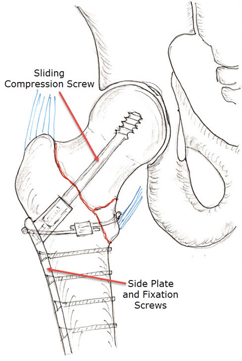 Hip Fracture Fixation