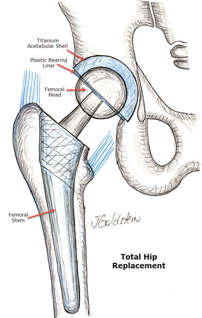 Hip Replacement