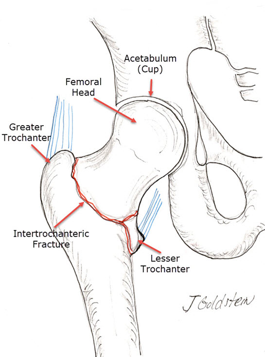 lesser trochanter fracture