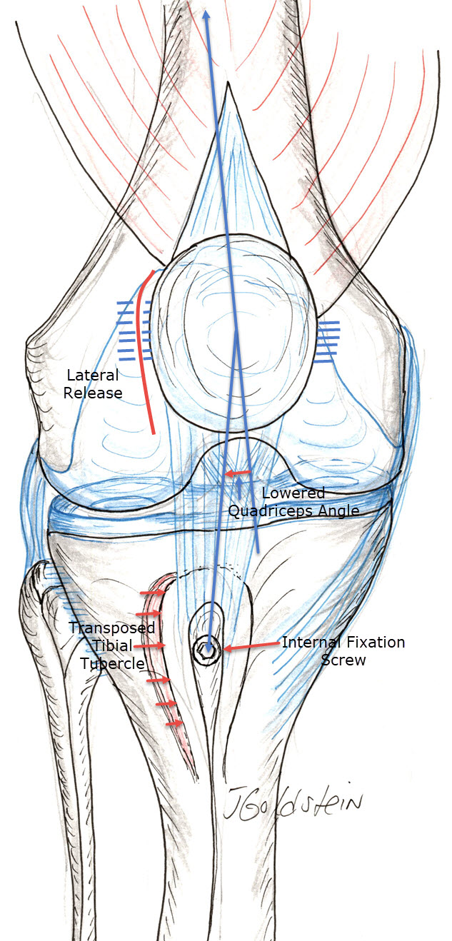 Knee Extensor Realignment