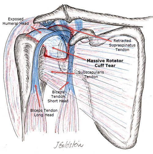 Massive Rotator Cuff Tear