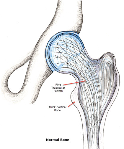 Osteoporosis