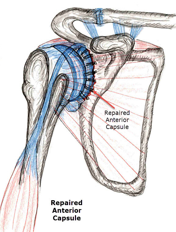 Repaired Anterior Shoulder Dislocation