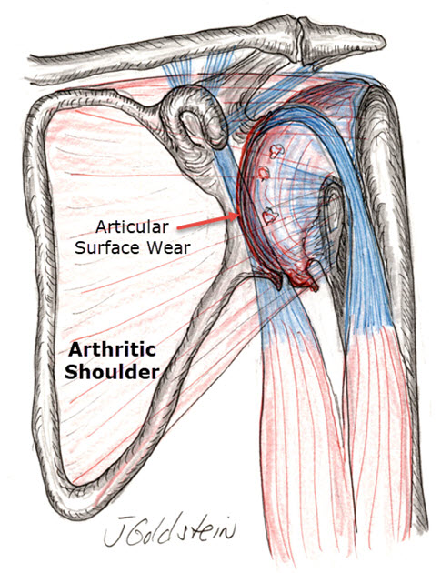 Shoulder Osteoarthritis