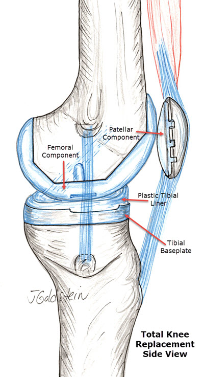 Total Knee Side View