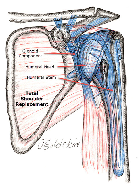 Total Shoulder Replacement