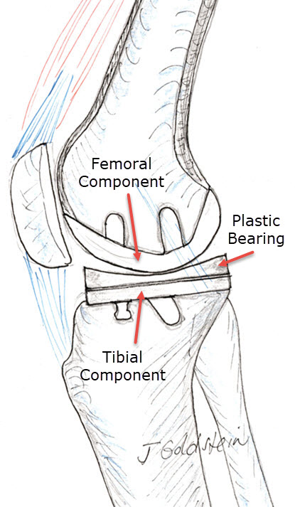 Unicondylar Knee Lateral